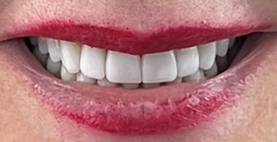 A photo of our happy client after procedure