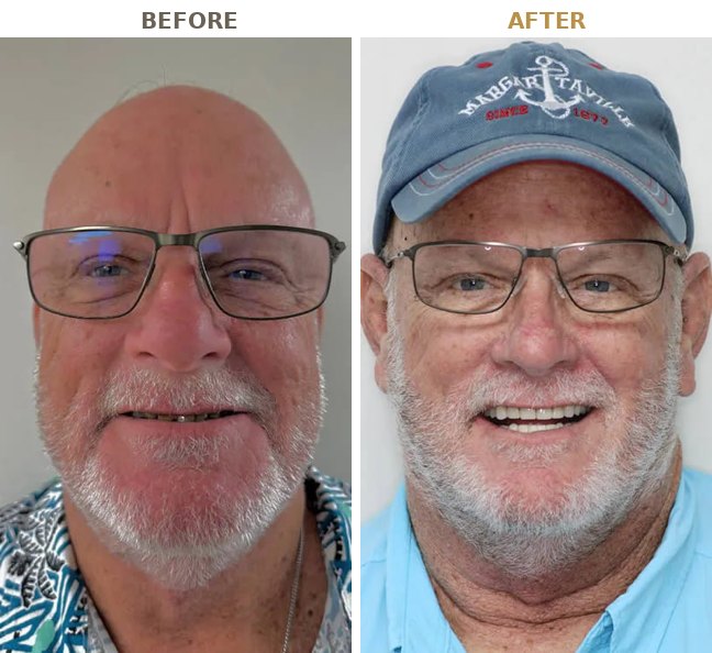Before and after porcelain veneers, a real B Well Dental Studio patient in Weston, FL