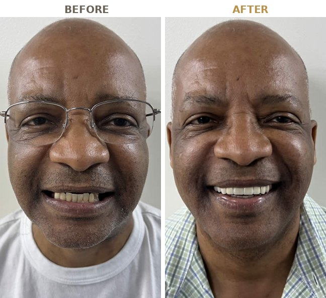 Before and after smile makeover at B Well Dental Studio in Weston, FL