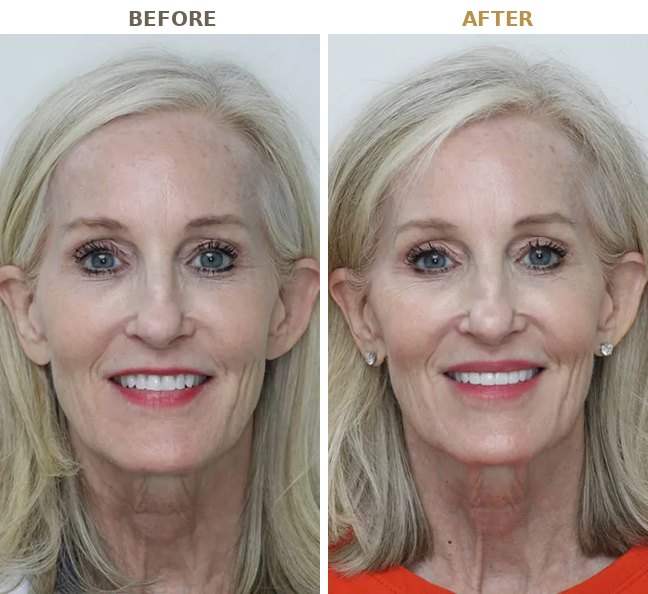 Before and after porcelain veneers, a real B Well Dental Studio patient in Weston, FL