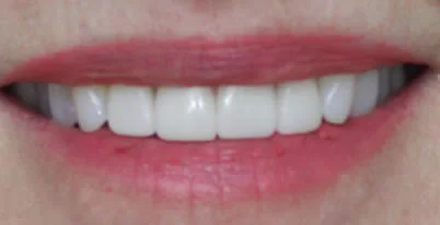 A photo of smile after