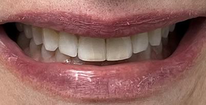 A photo of our happy client before procedure
