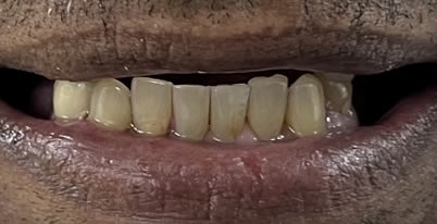 A close up phot before 