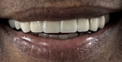 A photo of smile after